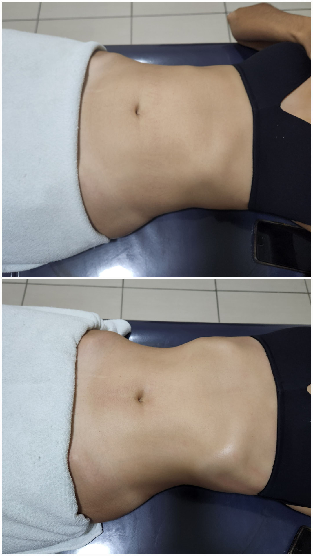Antes e depois da drenagem linfática, resultado 1